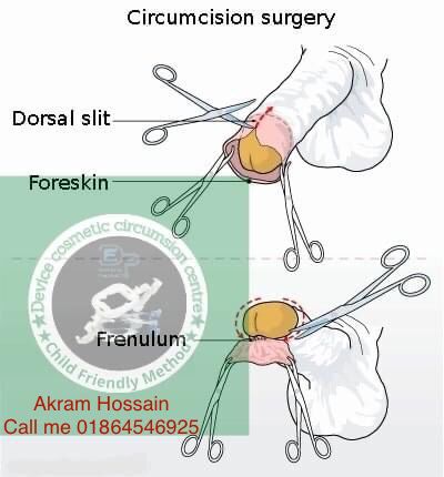 Alisklamp Circumcision Device (Pediatric Size No. 10,12,14,16,18). 